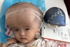 В Китае провели первую в мире операцию по уменьшению головы