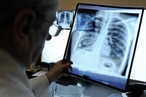 Российские ученые открыли механизм борьбы легких с туберкулезом